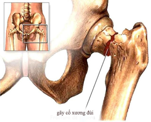 Hoại tử vô mạch - Hình ảnh minh họa